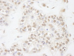 ATRX Antibody in Immunohistochemistry (IHC)