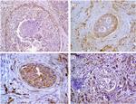 Fascin Antibody in Immunohistochemistry (IHC)