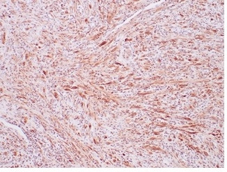 ALK (Anaplastic Lymphoma Kinase)/CD246 Antibody in Immunohistochemistry (Paraffin) (IHC (P))