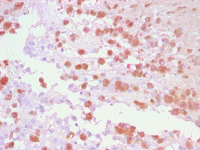 Tyrosinase-Related Protein-1 (TYRP-1) (Melanoma Marker) Antibody in Immunohistochemistry (Paraffin) (IHC (P))