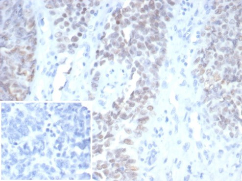 Wilm's Tumor 1 (WT1) (Wilm's Tumor and Mesothelial Marker) Antibody in Immunohistochemistry (Paraffin) (IHC (P))