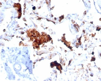 Napsin A (Lung Adenocarcinoma Marker) Antibody in Immunohistochemistry (Paraffin) (IHC (P))