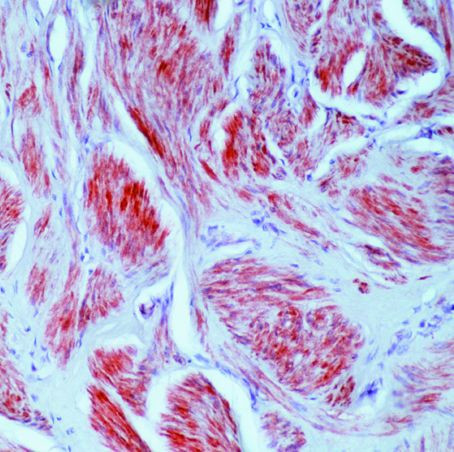 Caldesmon Antibody in Immunohistochemistry (Paraffin) (IHC (P))