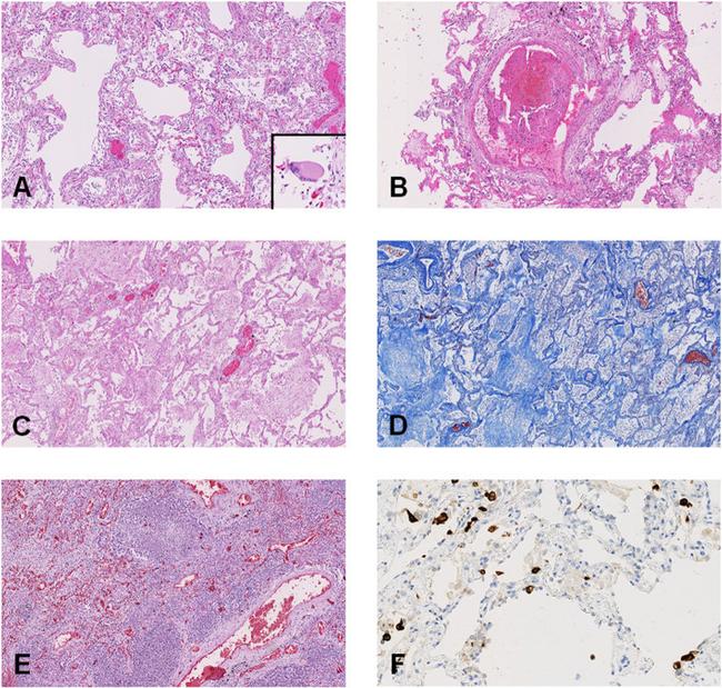 SARS Coronavirus Nucleocapsid Antibody in Immunohistochemistry (IHC)